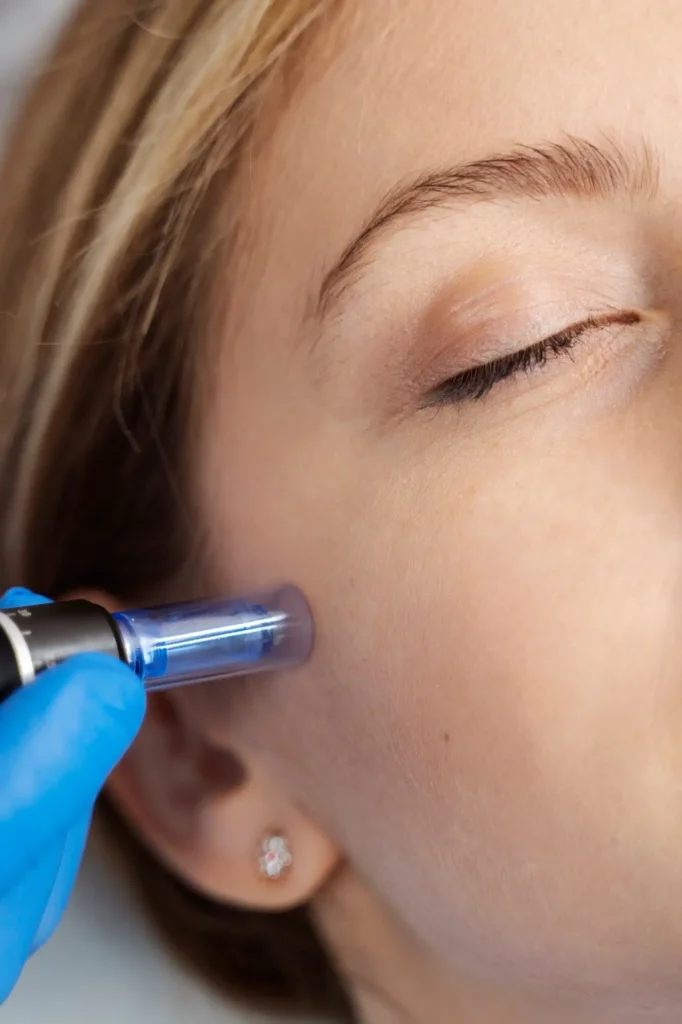 RF Microneedling Vs Regular Microneedling: Which One Is Right For You?