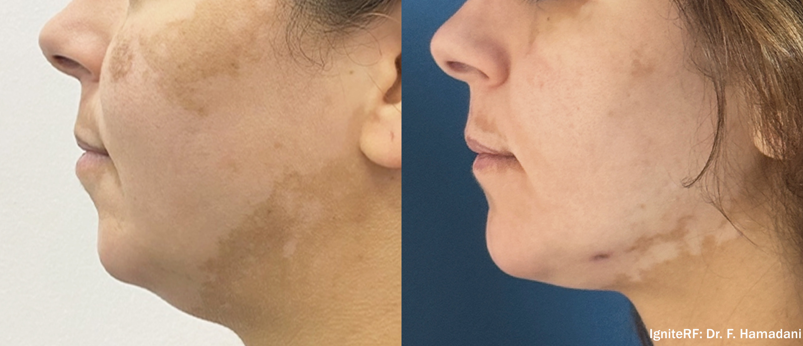 QuantumRF before and after result 7
