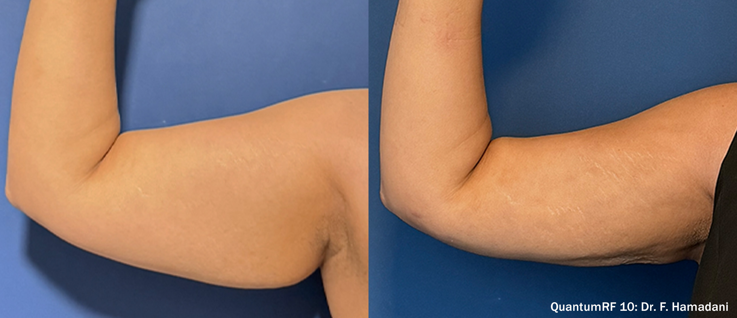 QuantumRF before and after result 6
