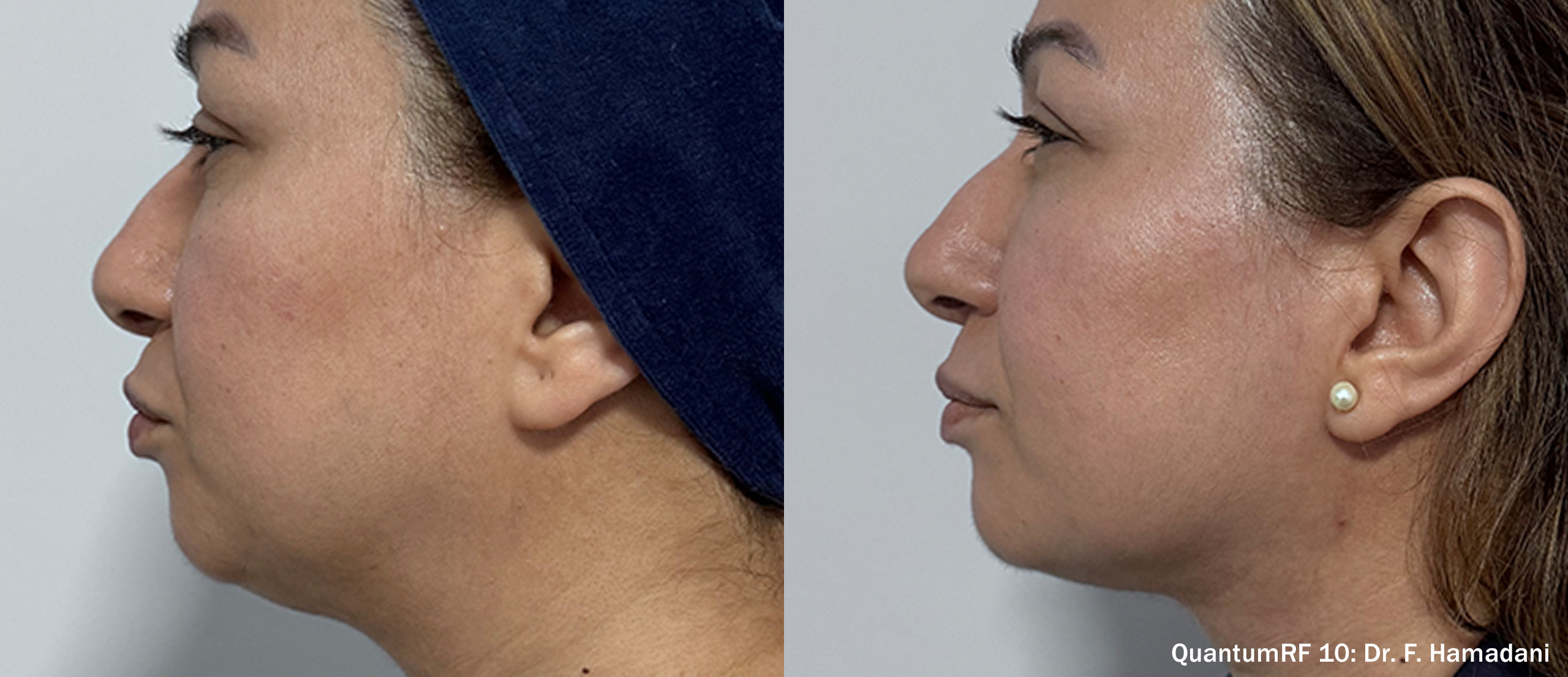QuantumRF before and after result 8